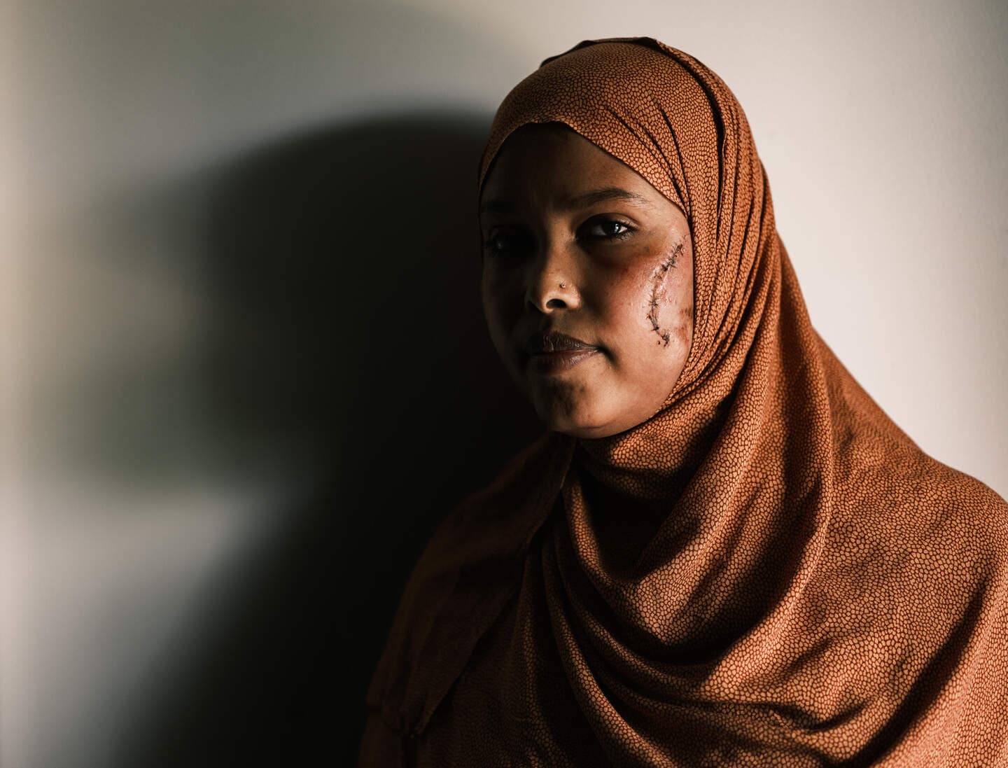 Somali Woman Left with Permanent Facial Scars After Alleged Random Attack in Central Dublin